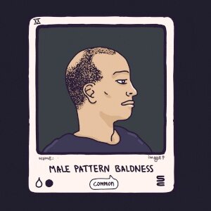 Male Pattern Baldness