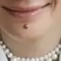 痣慧